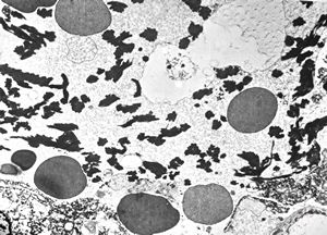 M,60y. | fibrinous pneumonia M,60y. | fibrinous pneumonia